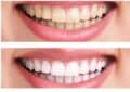 How Much Does Teeth Whitening Cost?