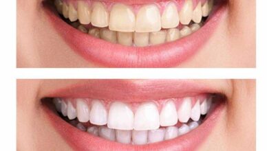 Teeth Whitening Cost